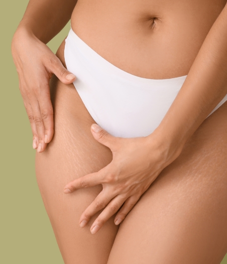 Frau zeigt Oberschenkel, symbolisiert anstehende Oberschenkelstraffung