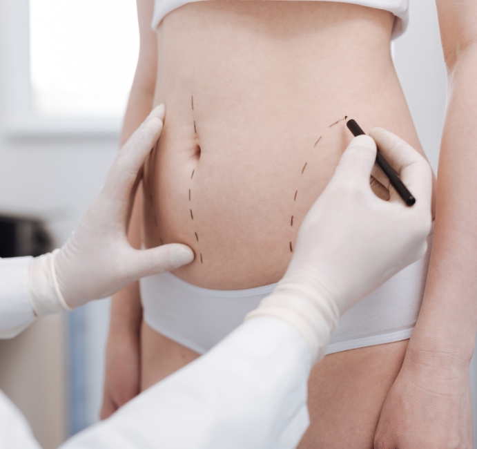 Markierungen am Bauch vor Körperbehandlung