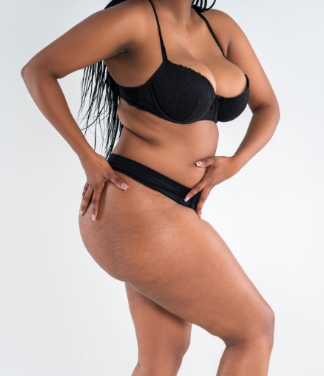 Frau in Unterwäsche hält ihre Hände auf Bauch und Hüfte, symbolisiert Lipödem-Behandlung