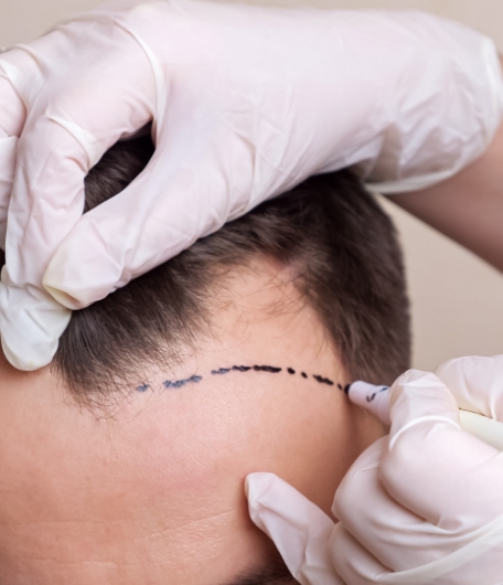 Markierung Haarlinie vor Haartransplantation